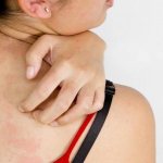 Itching after stress